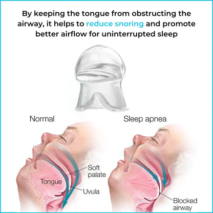 SnoreShield - Anti Snoring Device